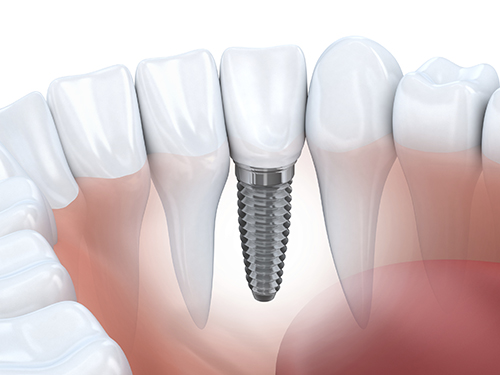Dental Implant Diagram iStock 000049511614 Large width of 500 pixels