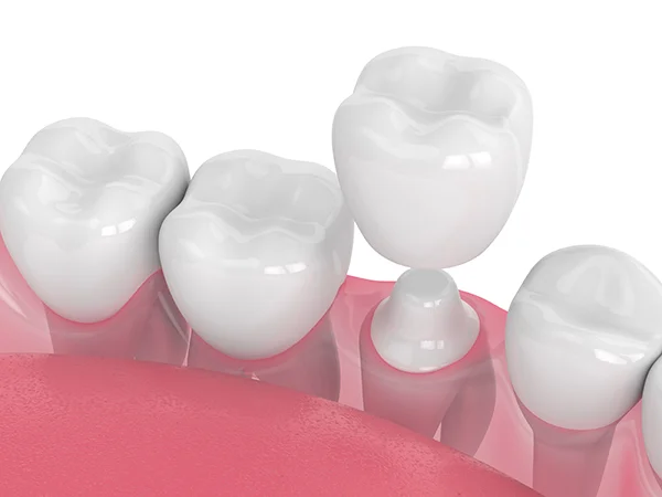 Close up 3D rendering of a dental crown being placed on a shaved down tooth