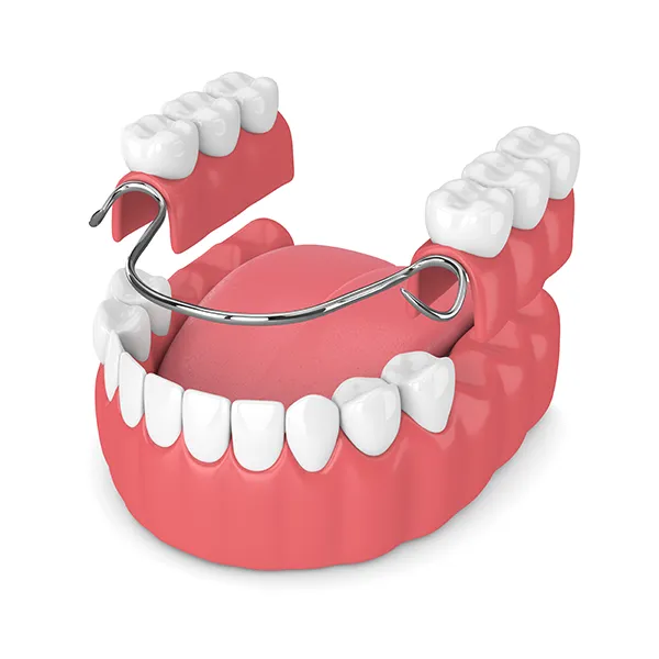 3D rendering of partial dentures being placed on a lower jaw with missing back teeth
