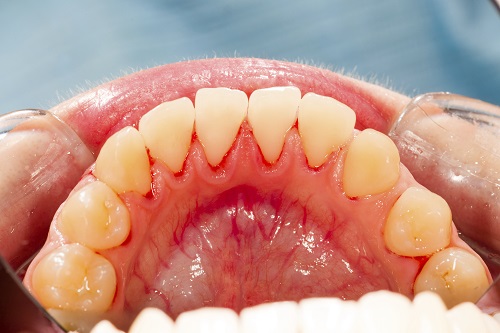 A close up of a patients mouth suffering from gum disease.